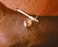 Photo: Guinea worm